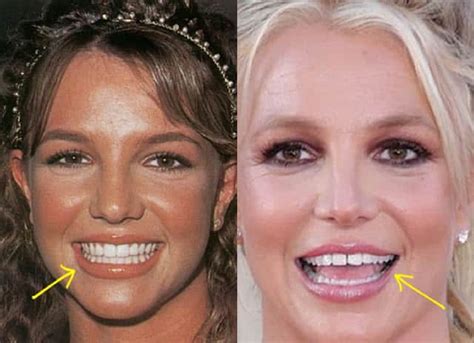 britney spears teeth|What Happened to Britney Spears: From Iconic Teeth。